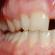 Почему у ребёнка растут зубы вторым рядом: как исправить дефекты Если зубы растут вторым рядом